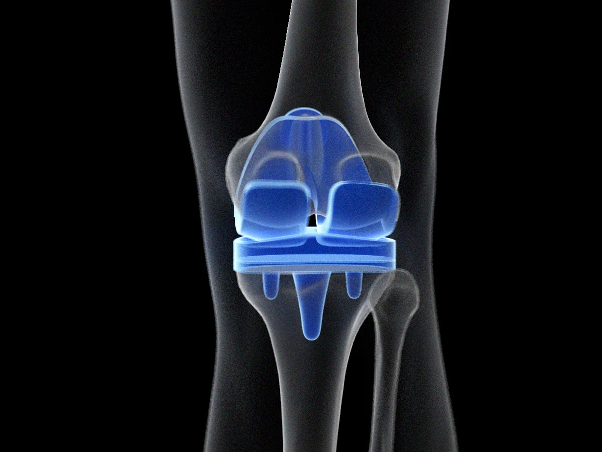Protesi del ginocchio