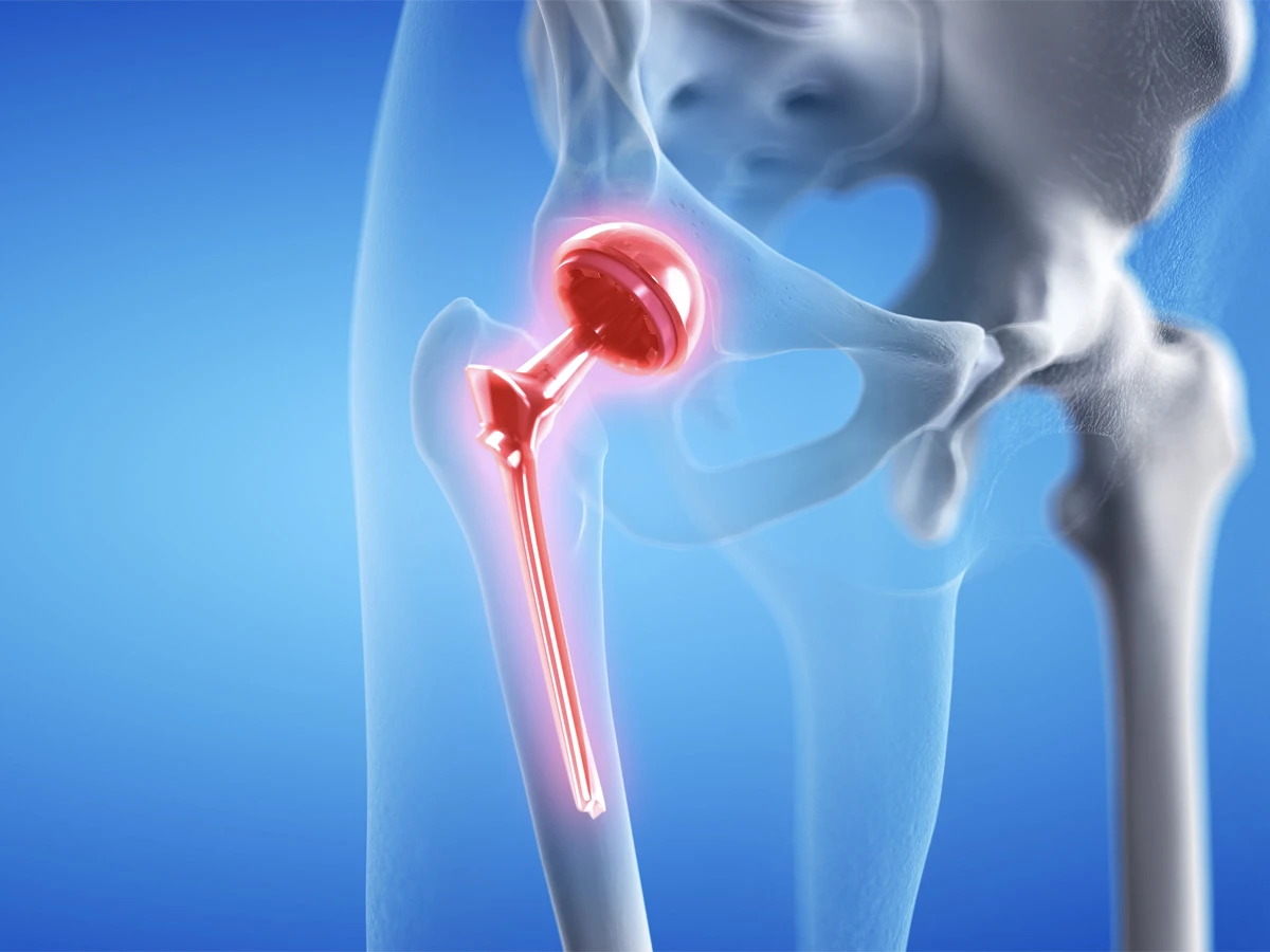 Protesi dell'anca
