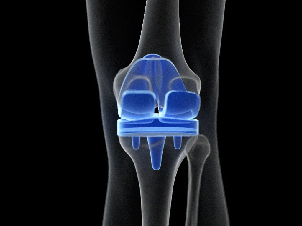 protesi del ginocchio