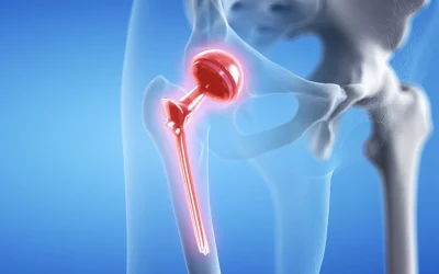 Protesi dell’Anca con Accesso Mini-Invasivo per Via Anteriore